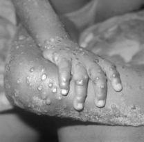 Confirmaron la primera muerte por mpox (viruela símica) en la Argentina